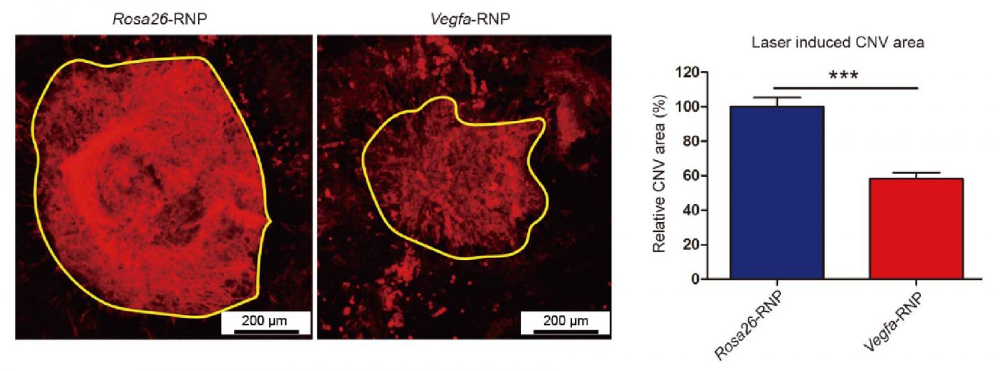 Comparing the Size of Choroidal Neovascularization in the Retina