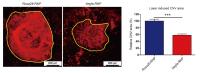 Comparing the Size of Choroidal Neovascularization in the Retina