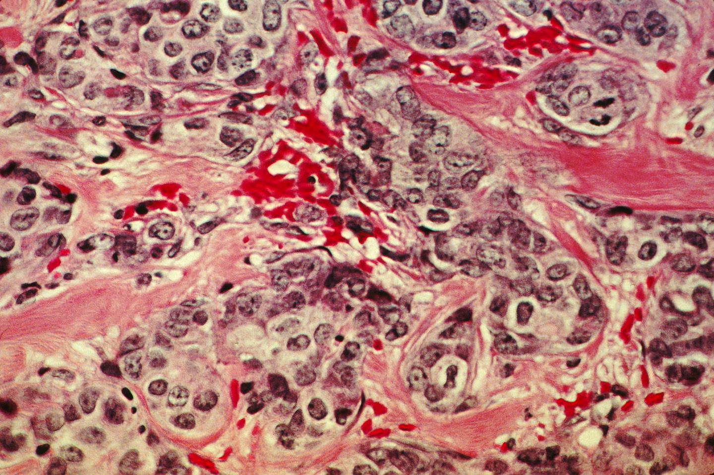 Breast Cancer Tissue