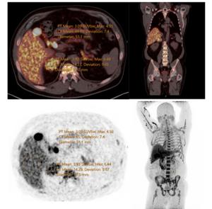 Statis PET-CT image of patient with hypercortisolism taken at 60 minutes post-injection.