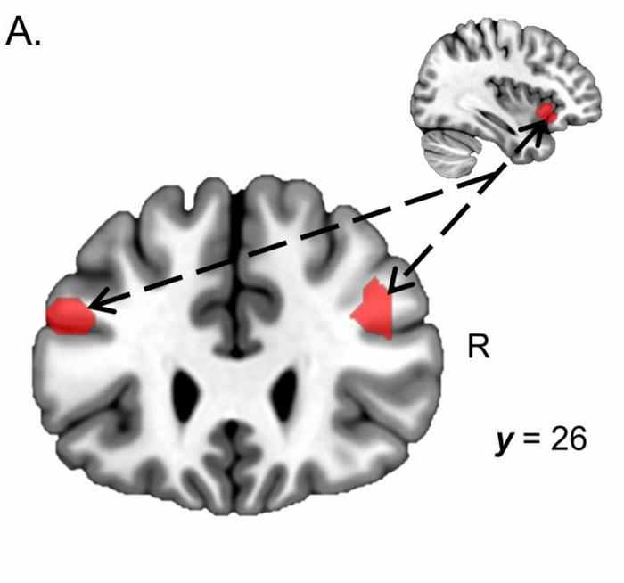 MRI image of a brain
