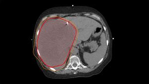 Sample radiation treatment plan