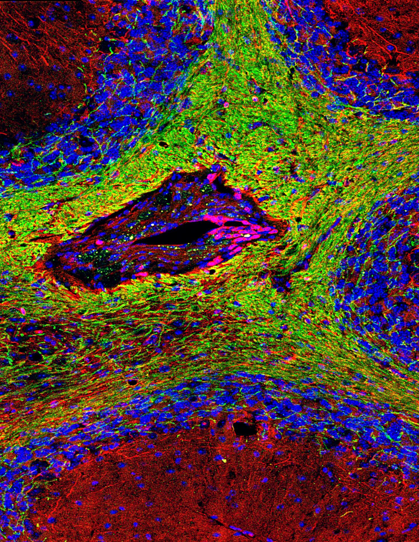 Lesion Typical Of Multiple Sclerosis