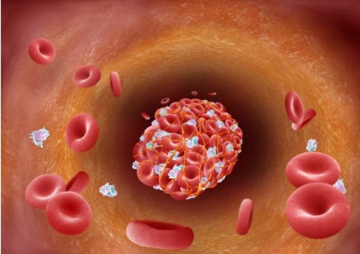 Blood Clot and Plaque Formation in an Artery