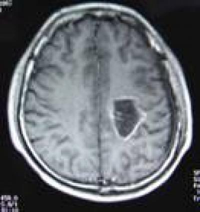 MRI Scan