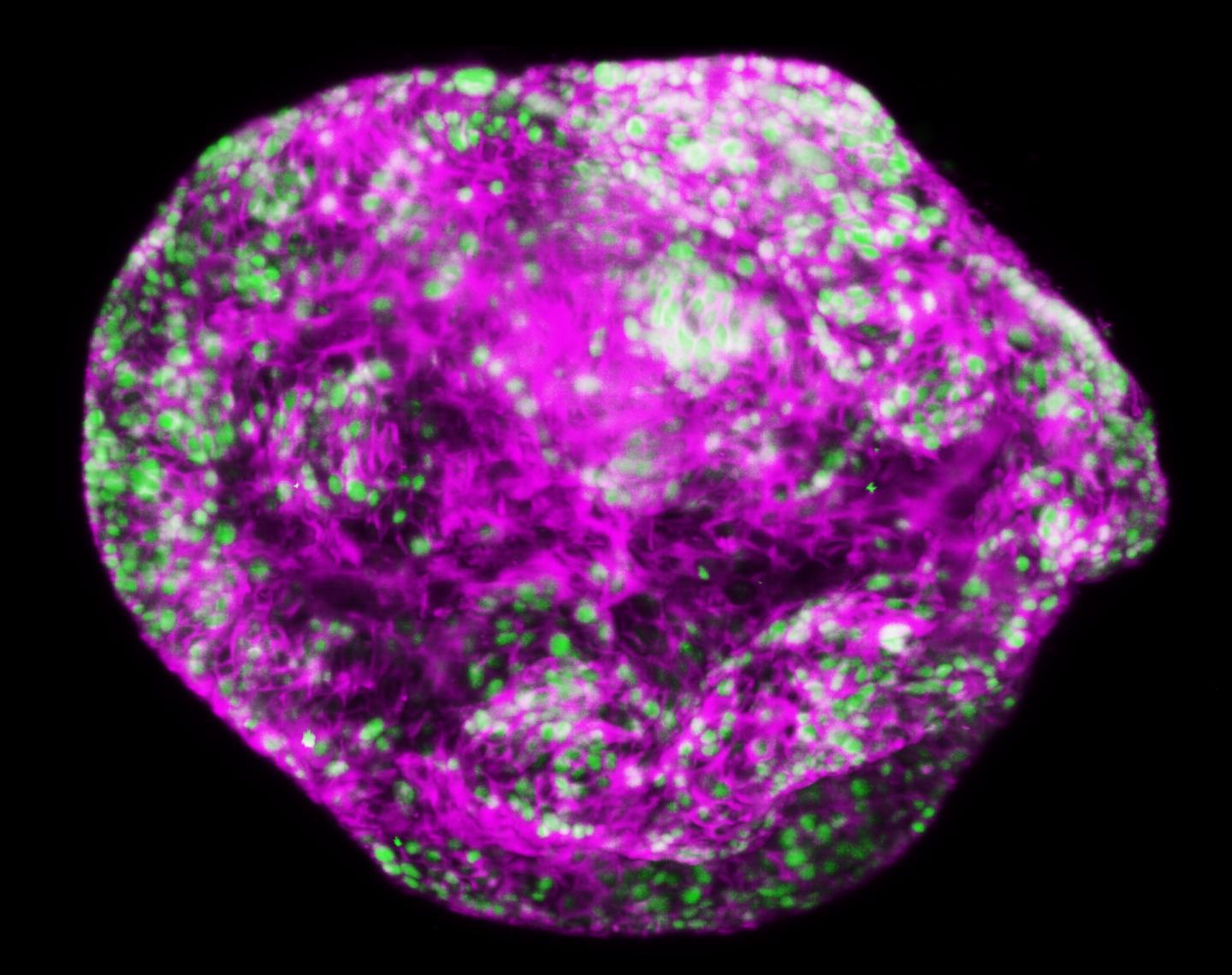 Gastric Cancer Cells under the Microscope