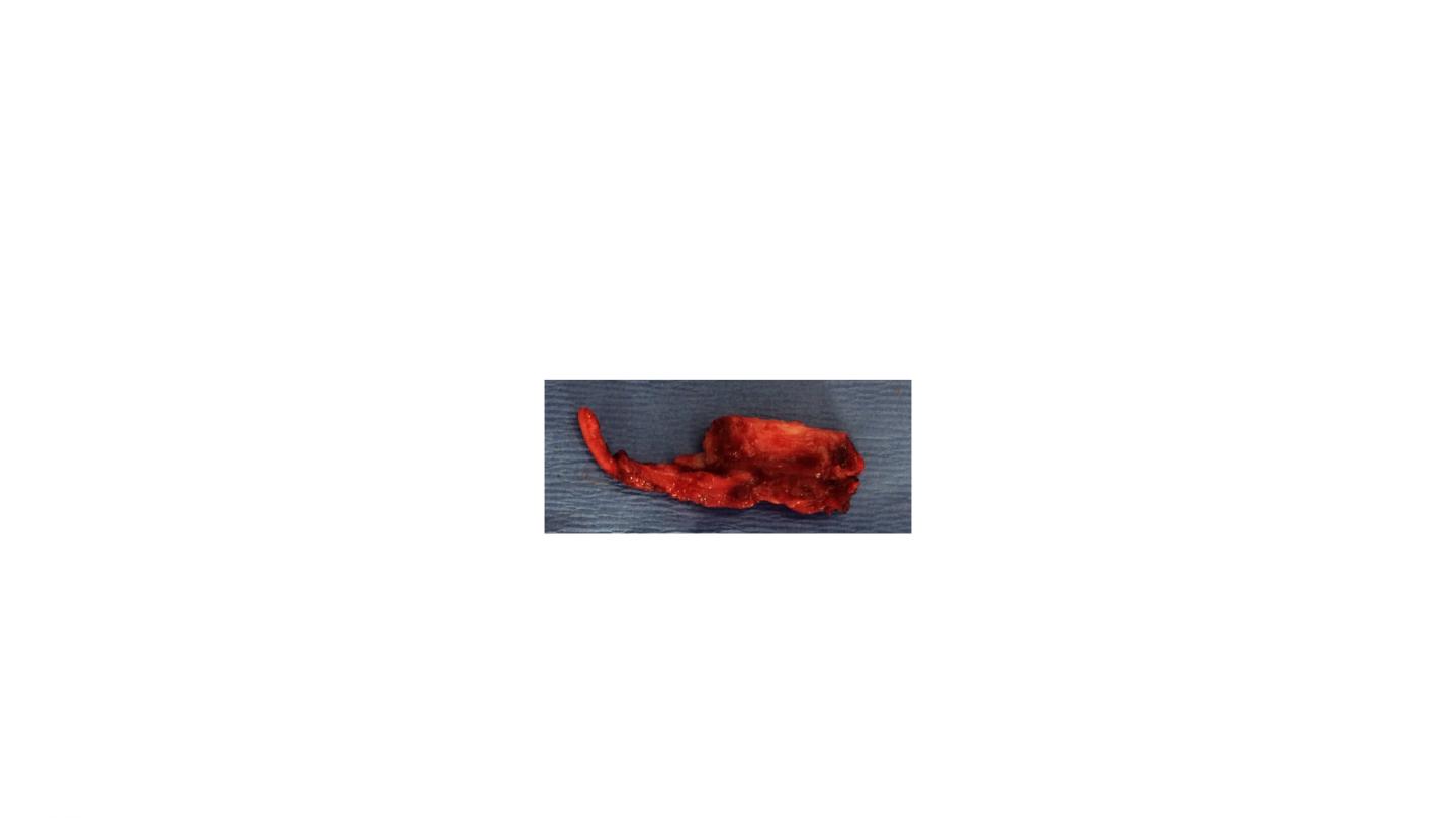 Bioreactor-Generated Bone With Blood Vessel For Reconstructive Surgery