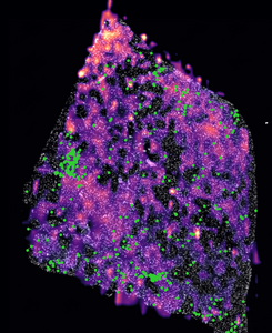 IDH-mutant human glioma tumor