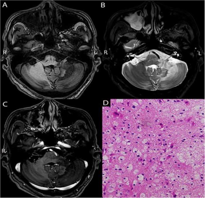 Magnetic resonance imaging (MRI) and pathological analysis of a patient with acute lymphoblastic leukemia