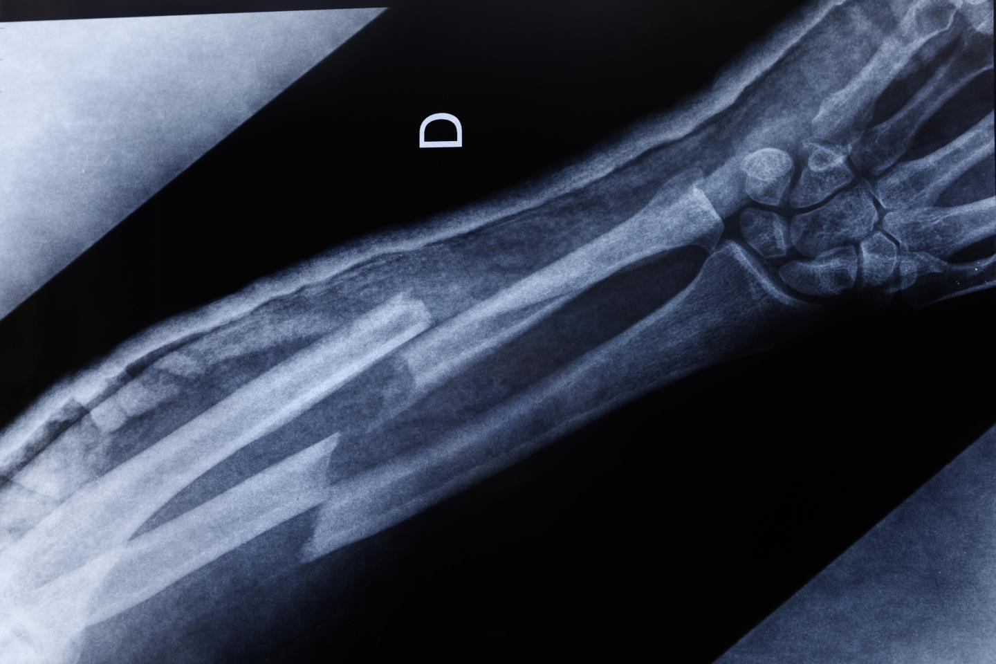 Diabetes and Bone