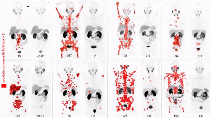 PSMA PET before and after lutetium-177 PSMA617 theranostics in 8 patients with metastatic prostate cancer.