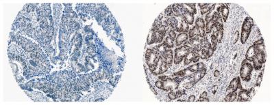 MCRS1 in Colorectal Cancer