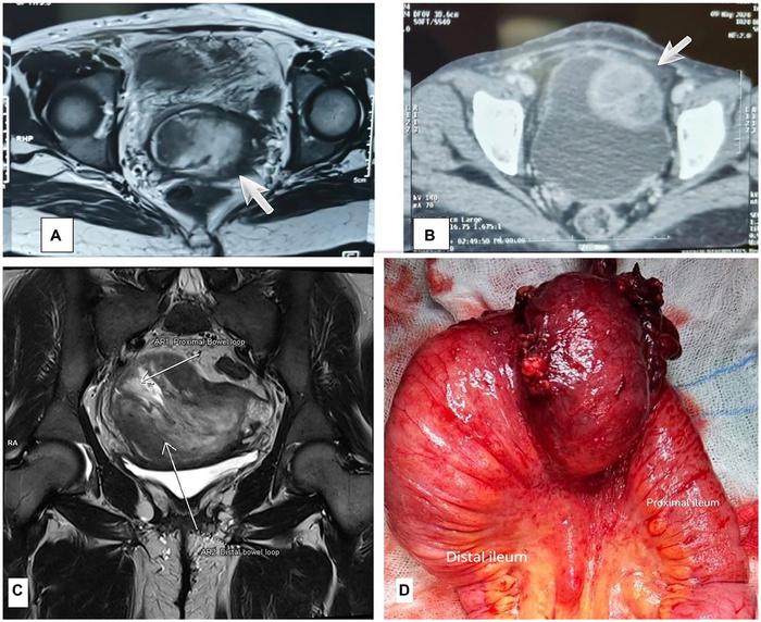 Ileal leiomyoma disguised as intussusception: Imaging pitfalls in a 28-year-old female