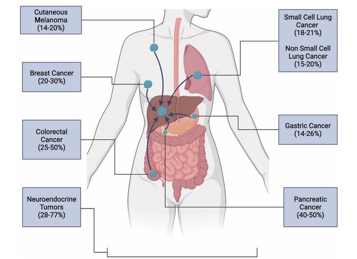 Liver metastases from primary organs by incidence.