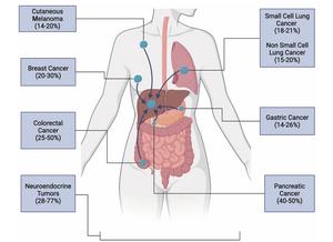 Liver metastases from primary organs by incidence.