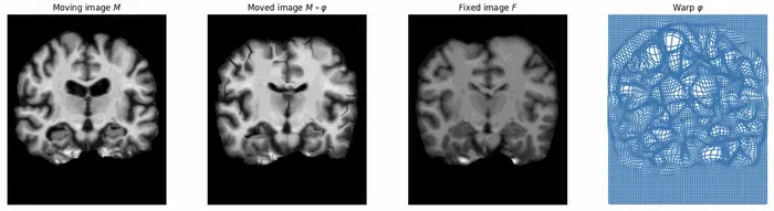 Comparing Brain Scans Using FireANTS