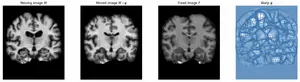 Comparing Brain Scans Using FireANTS