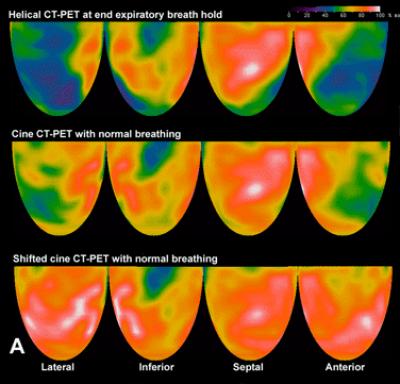 Comparison of 3 PET/CT Images