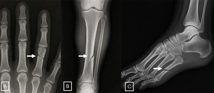 Examples of GPT-4o-generated X-rays of fractures