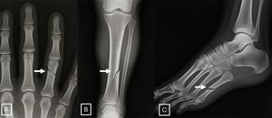 Examples of GPT-4o-generated X-rays of fractures