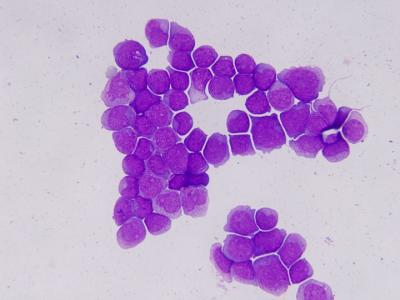 Acute Myeloid Leukemia