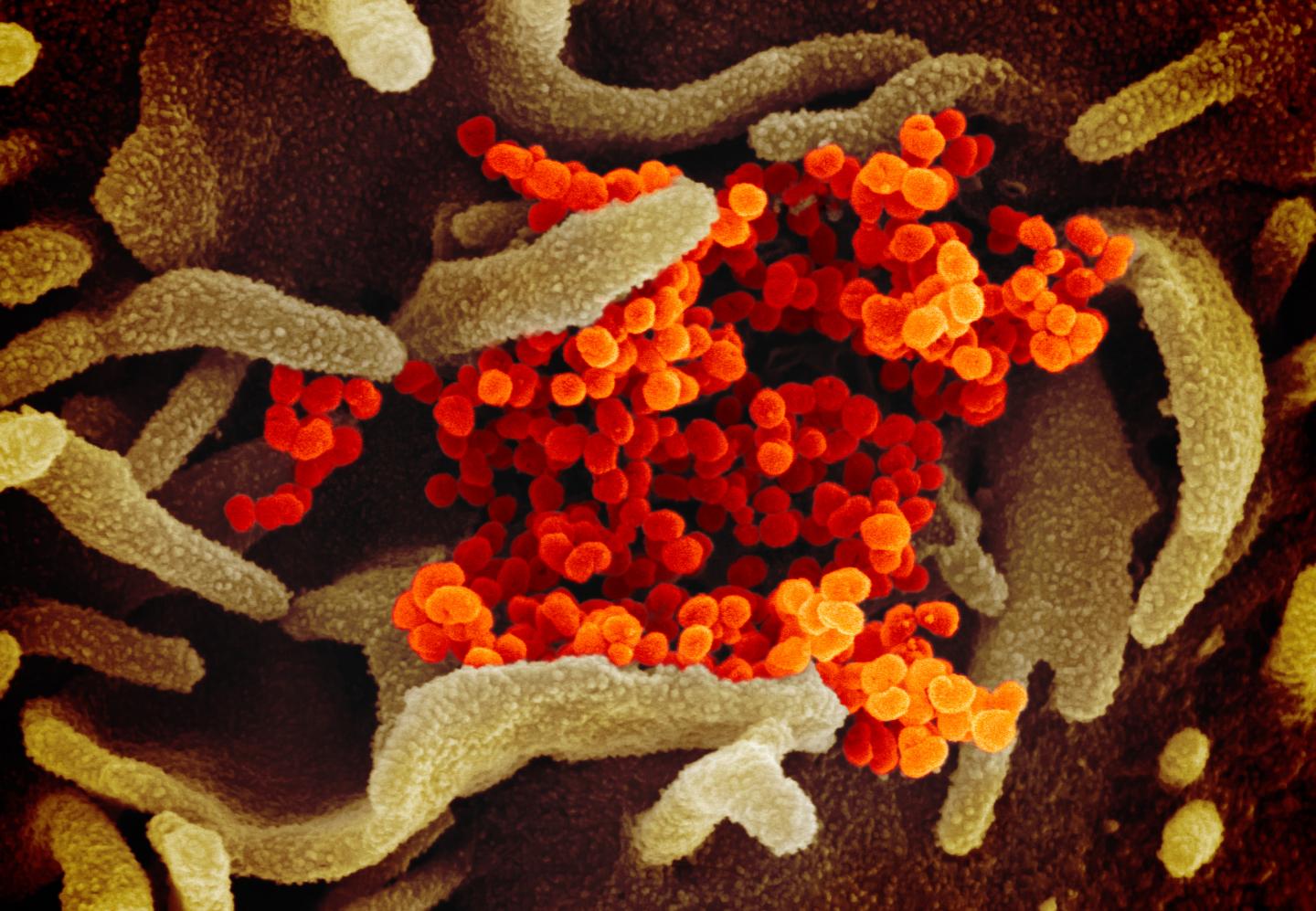 SEM of SARS-CoV-2