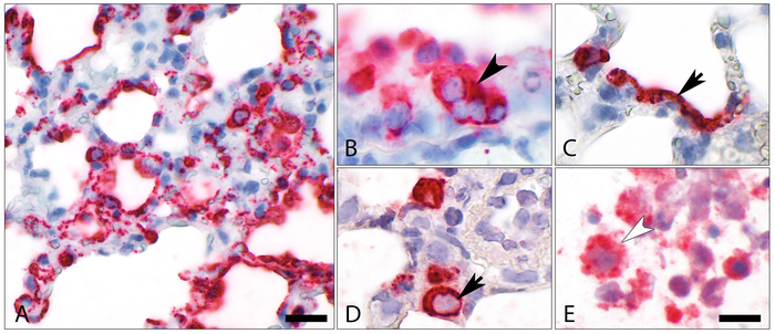 Infected lung tissue