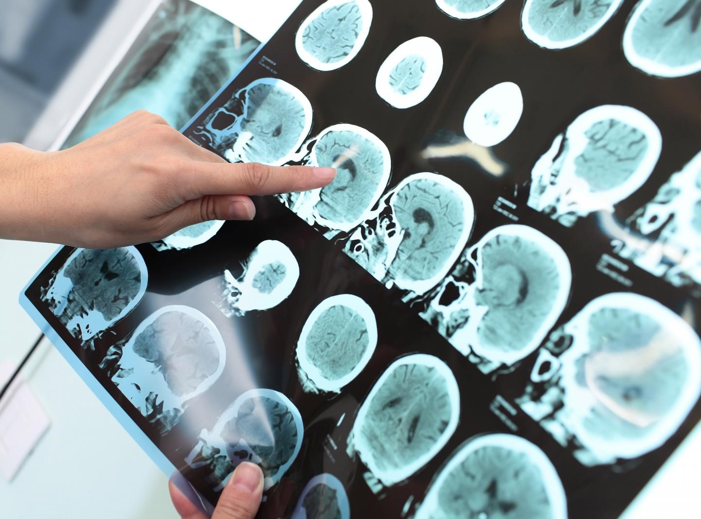 Aelan Cell Technologies Announces Development of Novel Alzheimer's Biomarker