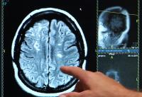 Survey: 73% of Those under 45 Likely to Put off Trip to the ER during Stroke Symptoms