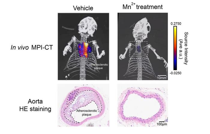 Manganese therapy enables the reversal of atherosclerotic plaque