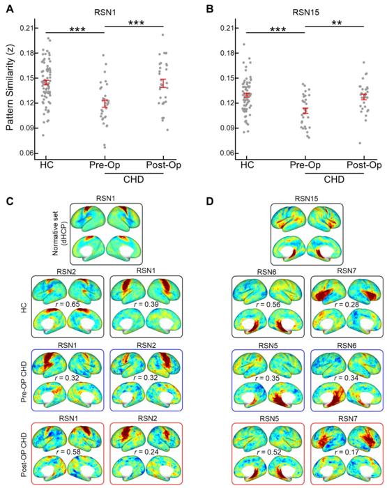 After cardiovascular surgery, brain networks of newborns with congenital heart disease recover.
