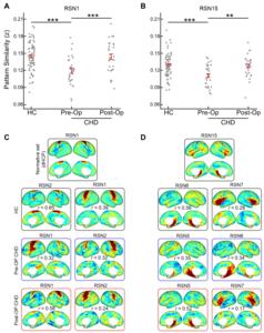 After cardiovascular surgery, brain networks of newborns with congenital heart disease recover.