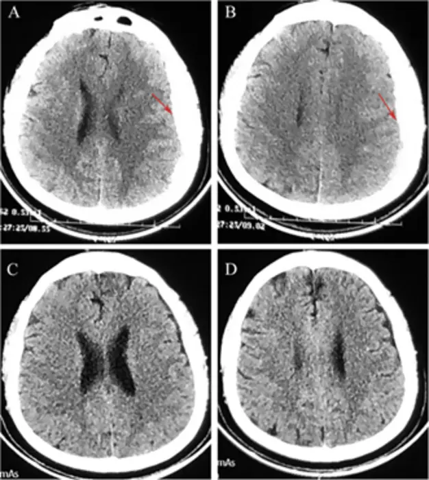 Non-surgical treatment with atorvastatin and dexamethasone for patients with subacute subdural hematoma