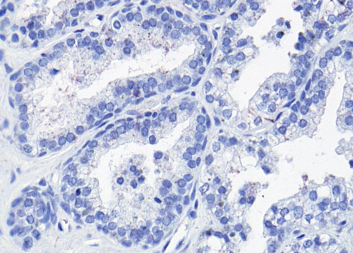 Unexpected Protein Modification Makes Prostate Cancer Invasive (1 of 2)