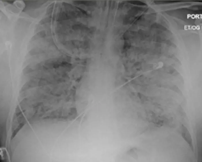 Severe acute respiratory distress syndrome (ARDS)