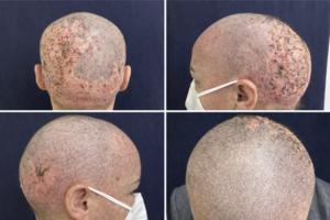 Erosive pustular dermatosis–like scalp reaction following cranial radiotherapy in a patient with EGFR-mutant NSCLC treated with amivantamab