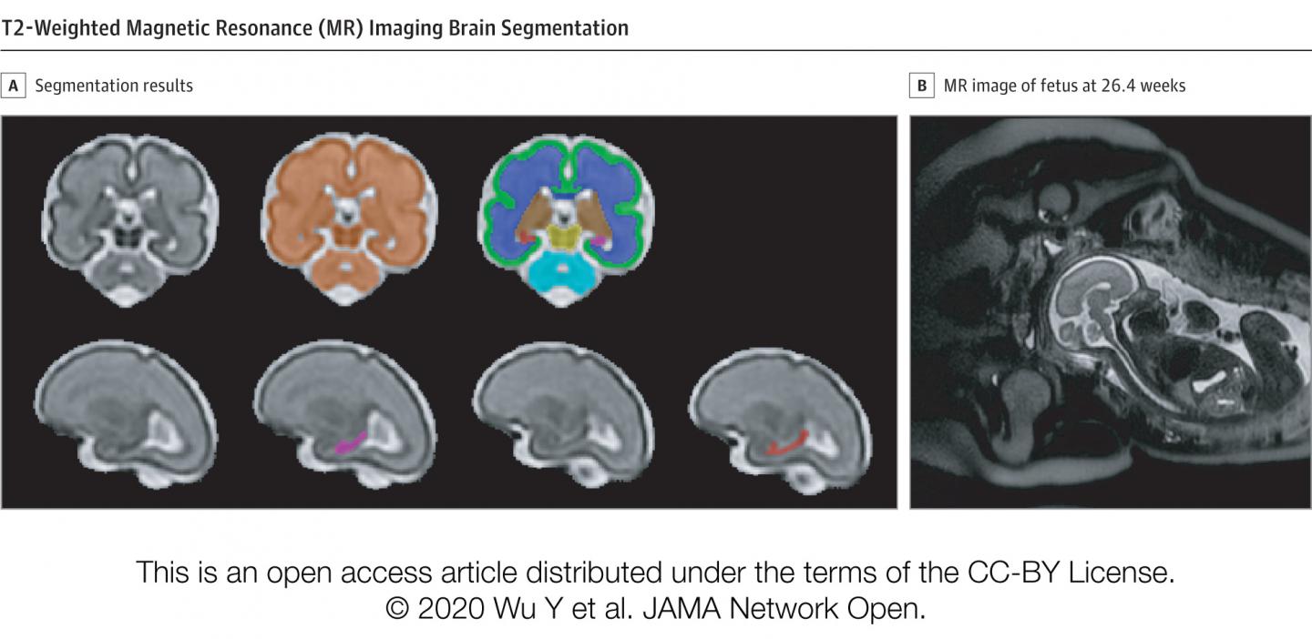T2-Weighted Magnetic Resonance (MR) Imaging Brain Segmentation