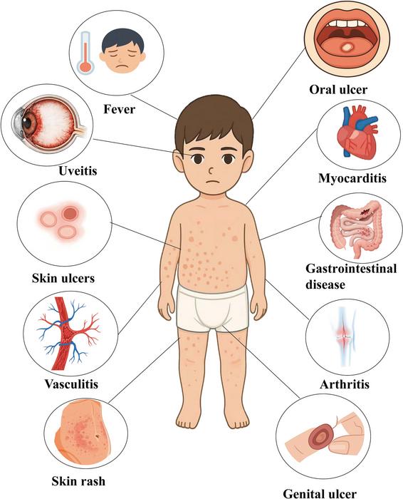 Clinical phenotypes which may appear in children with Behcet's spectrum disorders.