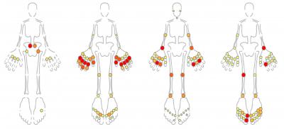 Examples of Distinct Patterns of Inflamed Joints in Childhood Arthritis