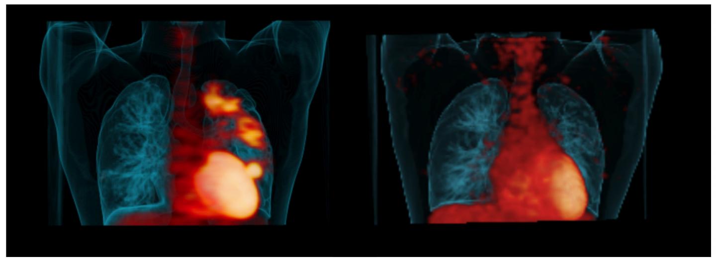PET Scans Reveal Anti-TB Drugs at Work
