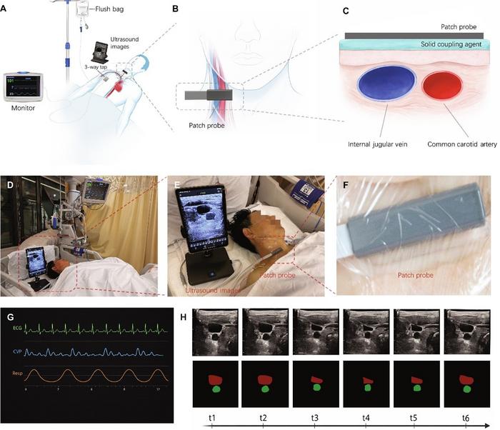 Wearable ultrasound-based monitoring of the right internal jugular vein, common carotid artery, and central venous pressure.