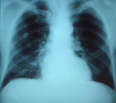 Pneumonia Bug