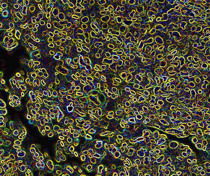 Kras/Lkb1 tumour