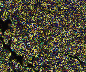 Kras/Lkb1 tumour