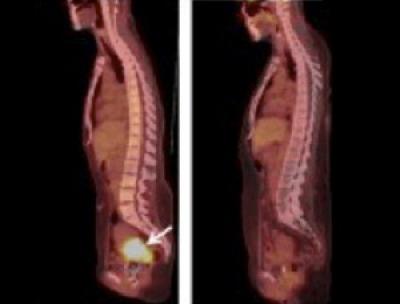 Pretesting Cervical Tumors Could Inform Treatment