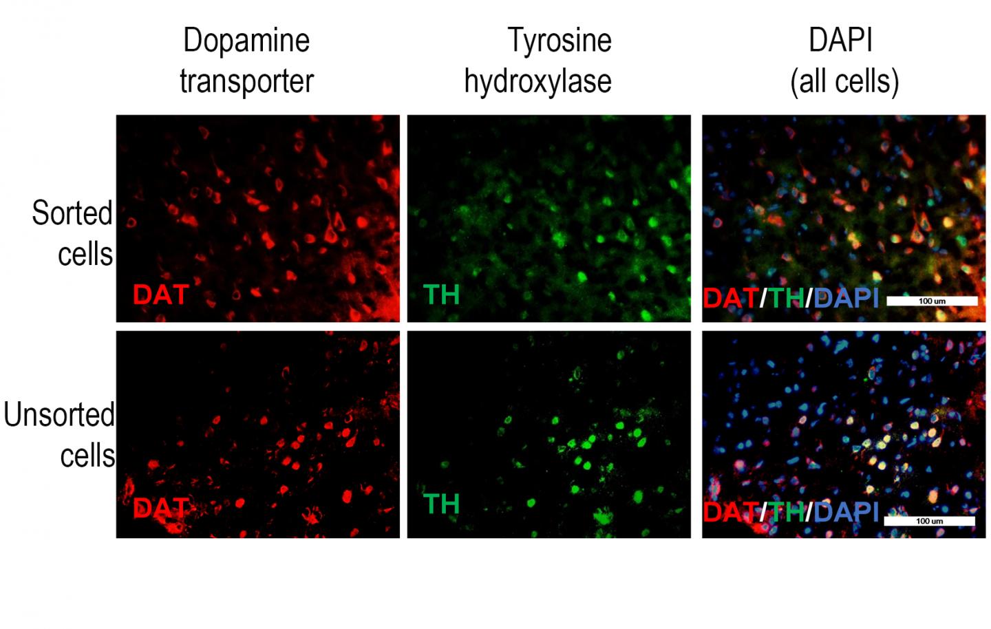 Cell Sorting Improves Cell Replacement Therapy For Parkinson's