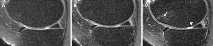 Knee MRI scans in a 58-year-old female participant in the Osteoarthritis Initiative who was administered a corticosteroid injection.