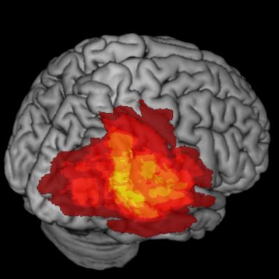 Lesioned Brain