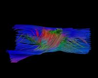 Fiber tract MRI