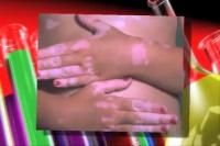 Vitiligo Research Video